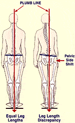 short-leg-syndrome-1.gif